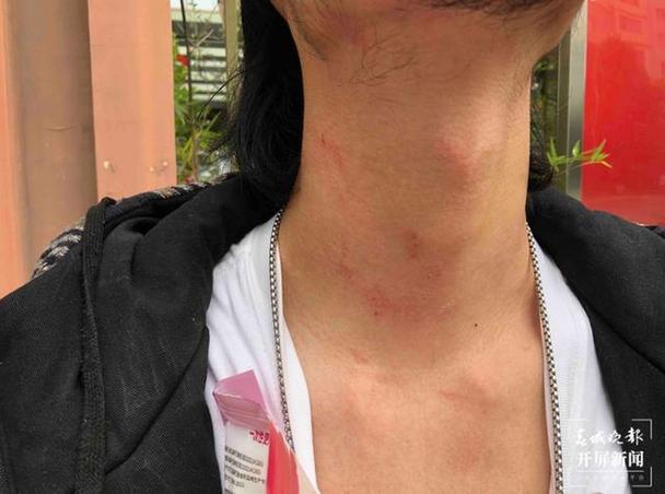 新澳天天彩免费大全和脖子被扎多根烧烤签与被烧烤签子扎出血了